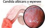 Candida albicans у мужчин