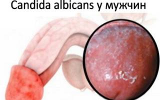 Candida albicans у мужчин