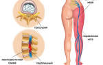 Капельницы при ишиасе