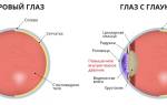 Глаукома заболевание глаз имеет две формы
