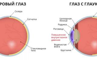 Глаукома заболевание глаз имеет две формы