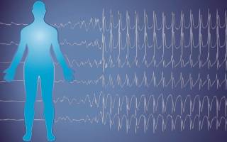 Как определить эпилепсию у взрослого