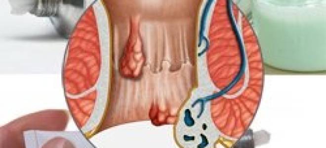 Лучшая мазь от внутреннего геморроя