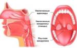 Воспаление аденоидов у взрослых симптомы