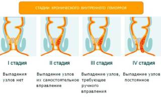 Какое средство лучше от геморроя