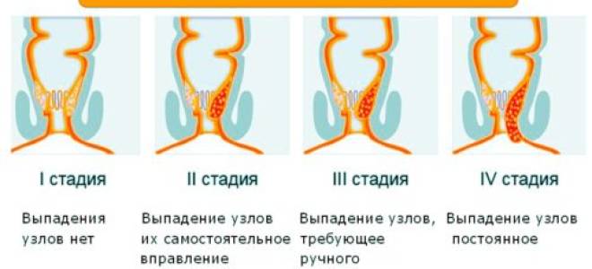 Недорогие средства от геморроя у женщин