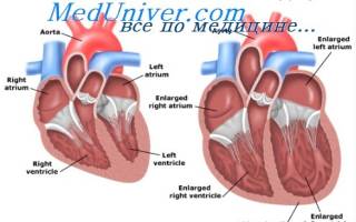 Сердечная недостаточность застойная причина