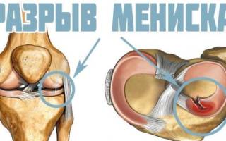 Боли в обоих коленях