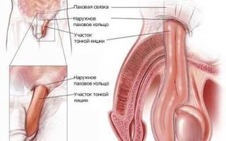 Грыжа яичка у мужчин фото