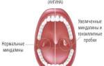 Что такое хронический тонзиллит у детей фото