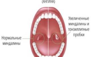 Что такое хронический тонзиллит у детей фото