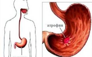 Атрофический гастрит схема лечения
