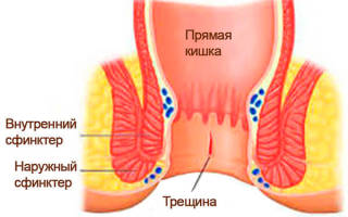 Разрыв прямой кишки фото