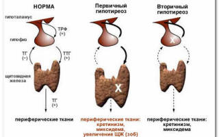 Симптомы гипоплазия щитовидной железы