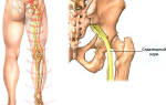 Воспаление седалищного нерва как долго лечится