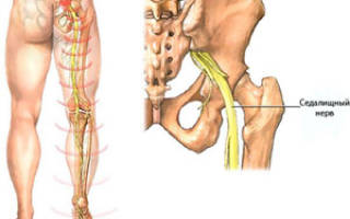 Воспаление седалищного нерва как долго лечится