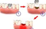 Альвеолит после удаления зуба симптомы лечение