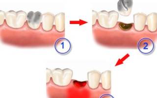 Альвеолит после удаления зуба симптомы лечение