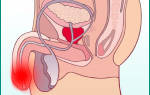 Резь при мочеиспускании у мужчин в головке без выделений и без запаха