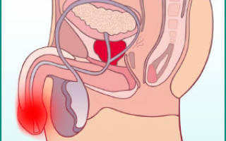 Резь при мочеиспускании у мужчин в головке без выделений и без запаха