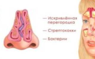 Избавиться от гайморита