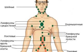 Лимфомиозот при увеличенных лимфоузлах