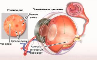 Разница в давлении в глазах