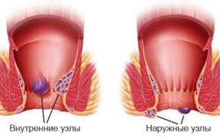 Виды геморроя и способы лечения