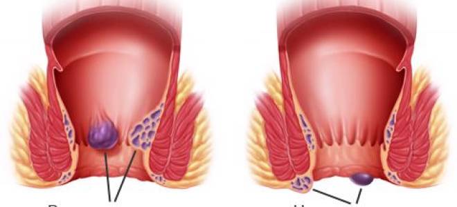 Виды геморроя и способы лечения
