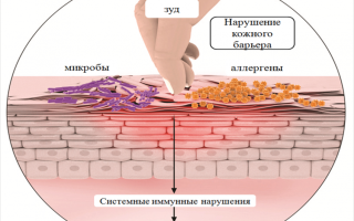 Экзема на ладонях фото