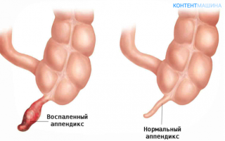 Вторичный аппендицит что это такое