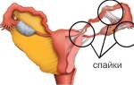 Рассасываются ли спайки в малом тазу