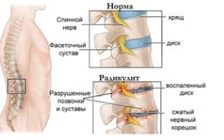 Грыжа поясничного крестцового отдела позвоночника последствия