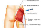 Ишиалгия седалищного нерва лечение таблетки