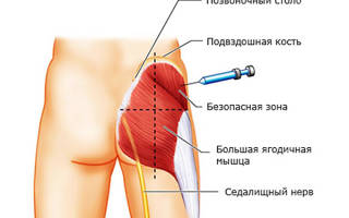 Ишиалгия седалищного нерва лечение таблетки