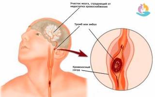 Микроинсульт симптомы первые и последствия