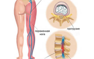 Защемление седалищного нерва какой врач лечит