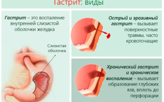 Тяжесть в правом и левом подреберье одновременно