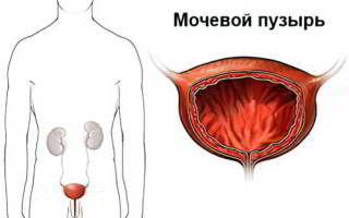 Признаки воспаление мочевого пузыря