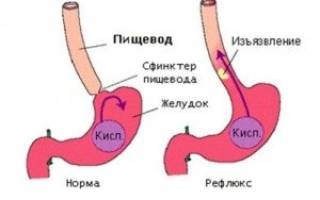 Заброс кислоты из желудка в пищевод лечение