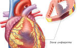 В каком возрасте может быть инфаркт