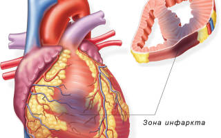 В каком возрасте может быть инфаркт