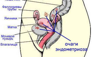 Цервикальный эндометриоз