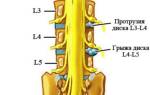 Грыжа позвоночника поясничного отдела лечение при острой