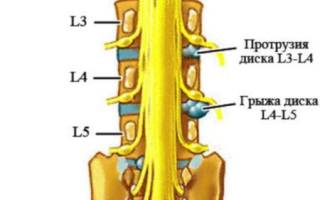 Грыжа позвоночника поясничного отдела лечение при острой