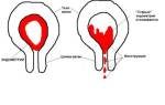 Маточные кровотечения при гиперплазии эндометрия