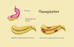 Чем лечится панкреатит поджелудочной