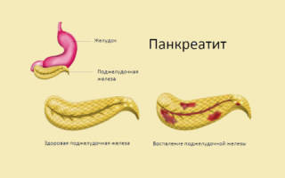 Чем лечится панкреатит поджелудочной