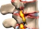 Острый остеохондроз позвоночника