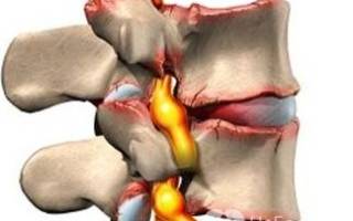 Острый остеохондроз позвоночника